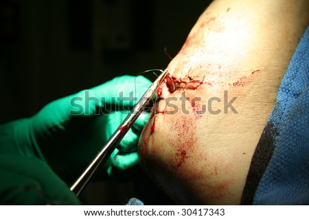 Medical, medical procedure, patient, injury, wound, cut, gash, doctor, hospial, medicine, physician, health care, accident, shot, numb