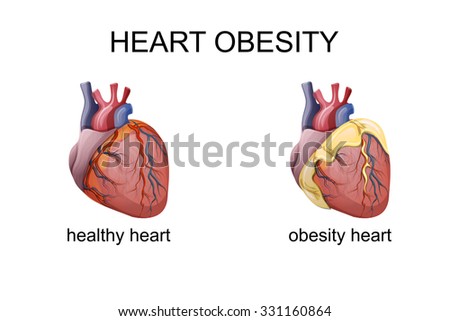 Illustration Of Obesity Heart Comparison Shutterstock