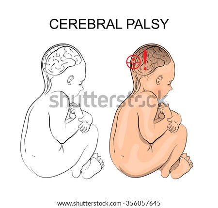 Cerebral Palsy Icd 10