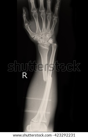 fracture shaft of radius & ulnar bone : right hand