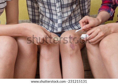 Asian woman with injured knees and sit on the sofa with her friends.