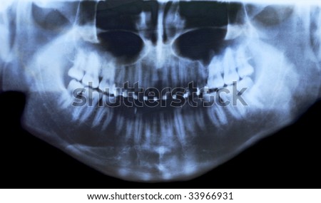 X-ray photo of teeth with braces