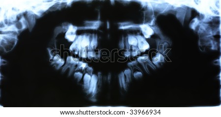X-ray photo of teeth the child. A constant teeth pushes out a milk teeth
