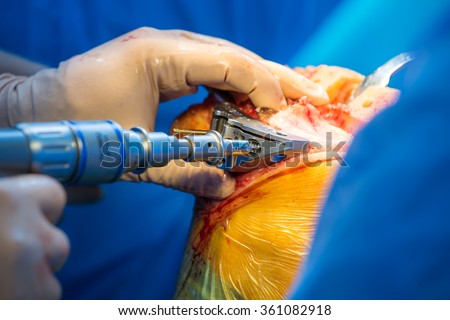 Surgeon working on the tibia in an arthritic knee, as part of a total knee arthroplasty