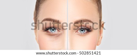 Lower Eyelid Blepharoplasty.