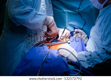 Doctors operating on patient, performing cardiac surgery