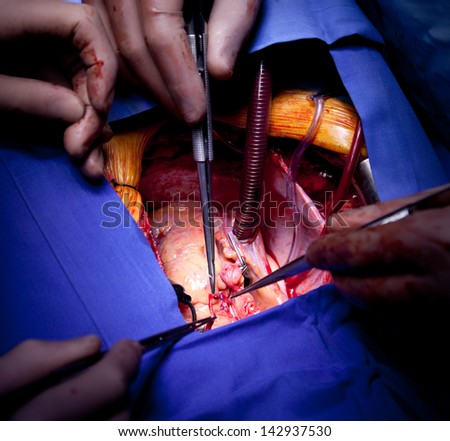 Detailed close-up of doctors hands performing cardiac surgery
