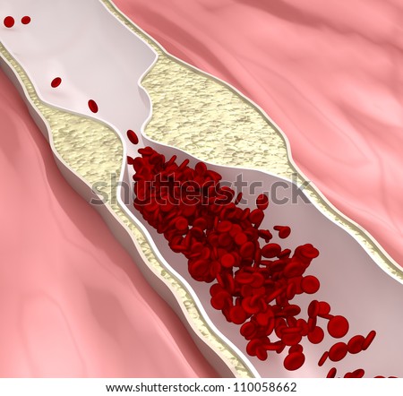 Atherosclerosis disease - plague blocking blood flow      *** also as footage available in my gallery