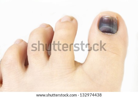 Subungual hematoma blue and black toe nail