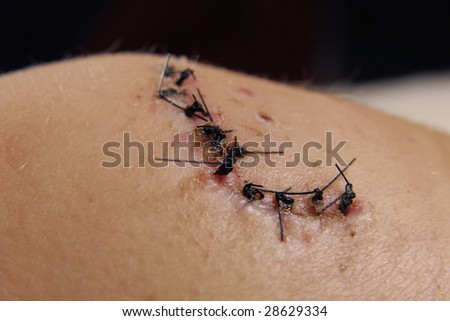 A wound in repaired using medical stitches (sutures).