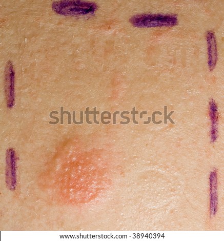 Patch Test Allergies
