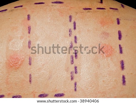 Skin Allergy Patch Test on Back of Patient Showing Redness and Swelling