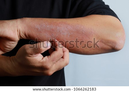 Close up dermatitis on skin, ill allergic rash dermatitis eczema skin of patient , atopic dermatitis symptom skin detail texture , Fungus of skin ,The concept dermatology, treatment fungal and fungal