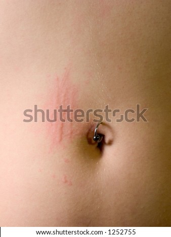 A woman\'s scratched belly with a piercing in the navel.