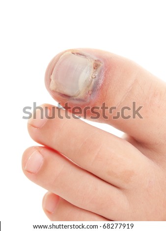 broken toe healing time. stock photo : Broken big toe