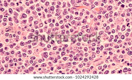 Lymphoma awareness: photomicrograph of a diffuse large B-cell lymphoma (DLBCL) a type of non-Hodgkin lymphoma.  This case is from the testis of an elderly man and shows prominent nucleoli.