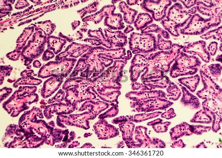 Thyroid cancer: Microscopic image of papillary thyroid carcinoma, characterized by branching papillae with fibrovascular cores (photographed and uploaded by US board-certified surgical pathologist).