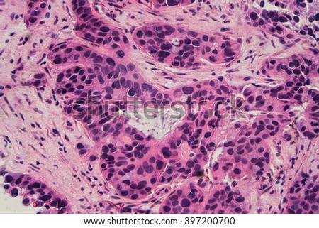 Breast cancer: Microscopic image of a moderately differentiated, grade 2, infiltrating (invasive) ductal carcinoma (photographed and uploaded by US board-certified surgical pathologist).