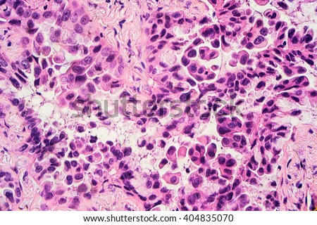 Lung cancer - adenocarcinoma: Therapies targeting specific genetic alterations such as EGFR, ALK and ROS1 are appropriate for selected cases (photographed and uploaded by US surgical pathologist).