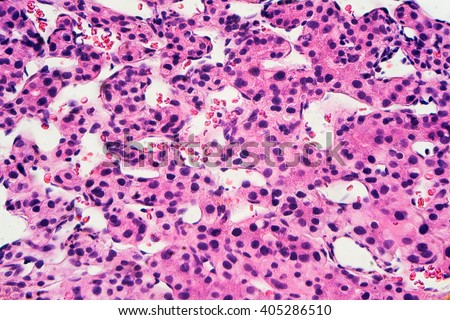 Liver cancer: Hepatocellular carcinoma (hepatoma) is a malignant tumor  often associated with chronic hepatitis B (photographed and uploaded by US board certified surgical pathologist).