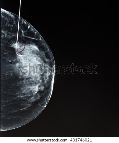 Mammogram showing wire guided (needle) localization of  a small breast cancer, previously identified by screening.  This helps the surgeon locate the exact area for excisional biopsy (lumpectomy).