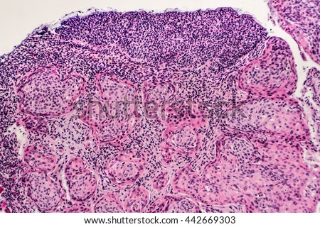 Cervical Cancer: Invasive squamous carcinoma arising in association with severe squamous dysplasia (CIN III, HSIL), related to HPV (human papilloma virus). HPV vaccination in teens can be preventive.
