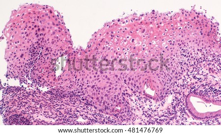Photomicrograph (microscopic image) of cervix biopsy showing low grade squamous intraepithelial lesion (LSIL, mild dysplasia, CIN 1) due to human papilloma virus (HPV).  HPV vaccine is now available.