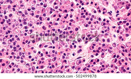 Multiple Myeloma Awareness: Pathology microscopic of bone biopsy of multiple myeloma, a type of bone marrow cancer of malignant plasma cells, associated with bone pain, bone  fractures and anemia.