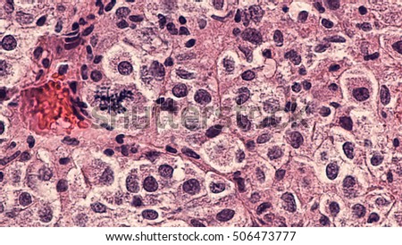 Metastatic Melanoma: Melanoma, the most lethal type of skin cancer which is associated with sun exposure, has a propensity to metastasize.  This biopsy is from a urinary bladder.