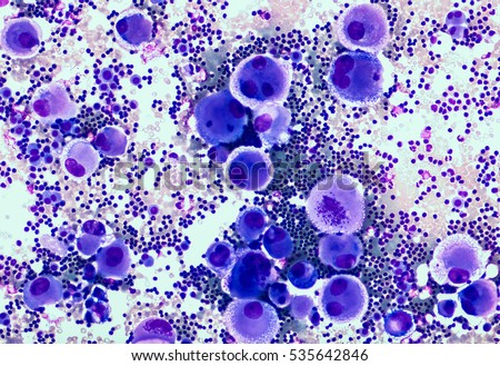 Malignant fluid cytology;   Malignant cells of adenocarcinoma may spread to fluid of  pleural or peritoneal cavity in cancer from the breast,  lung, colon, pancreas, ovary, endometrium or other sites.