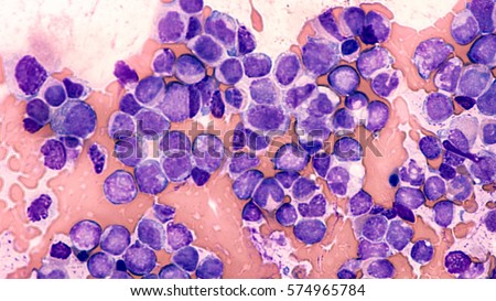 Leukemia Awareness: Photomicrograph of bone marrow aspirate from a patient with leukocytosis, showing blast cells of acute myeloid leukemia (AML), type M5 (myelomonocytic).
