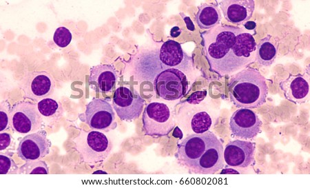 Fine needle aspirate cytology of metastatic melanoma, with large malignant cells.  In the center of this photomicrograph is an \