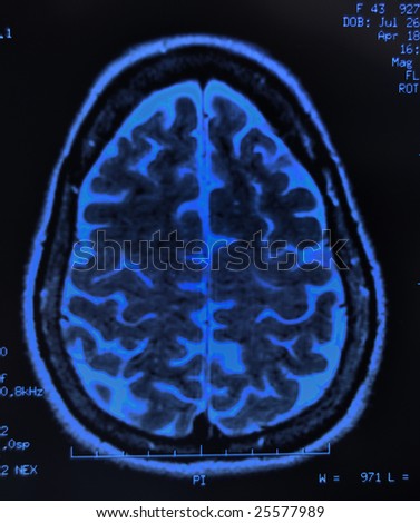 magnetic resonance image (MRI) of the brain
