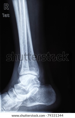 human foot ankle and leg xray picture