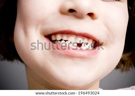A child smiling showing off a missing tooth.