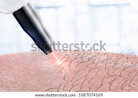 cosmetology procedure laser hair removal on body parts. Laser epilation.