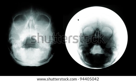 Children's skull x-ray image