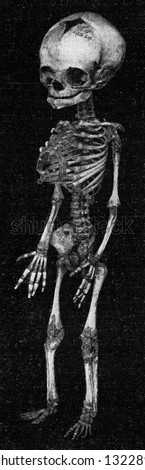 Skeleton of a newborn child with arms and legs of the same length, vintage photo. From the Universe and Humanity, 1910.