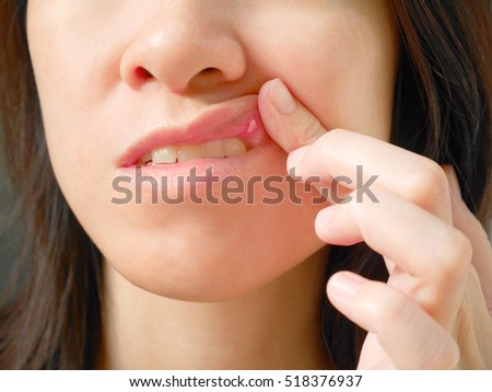 Canker sore on woman upper lip