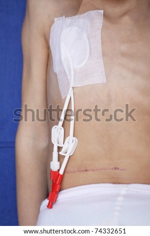 a caucasian child suffering from cancer with a hickman catheter for administering chemotherapy also showing a scar from a nephrectomy