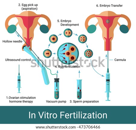 how artificial insemination is done and in vitro fertilization works how artificial insemination is done and in vitro fertilization works