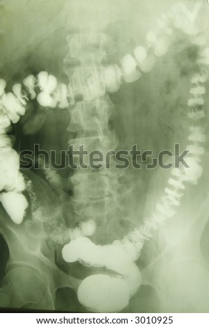 x-ray photo of a vertebra and pelvic area