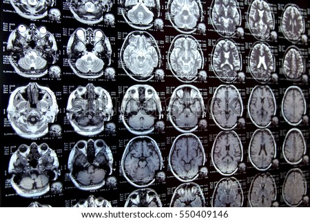 Closeup view of a MRI head scan with brain and skull on it with perspective.
