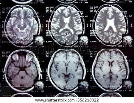 Closeup view of a MRI head scan with brain and skull on it. Blue toned.