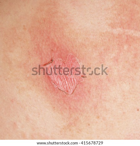 macro texture of human skin stock photo more pictures of abstract istock macro texture of burns on human skin back stock photo 415678729 macro texture of human skin stock photo more pictures of abstract istock macro texture of burns on human skin back stock photo 415678729