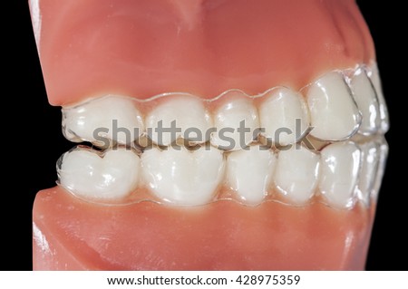 invisible orthodontic aligners for treatments bruxism grinding teeth