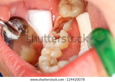 Caries and cavity in molar teeth