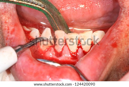 Caries and cavity in molar teeth, course of treatment
