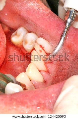 Caries and cavity in molar teeth, course of treatment