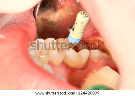 Caries and cavity in molar teeth in course of treatment